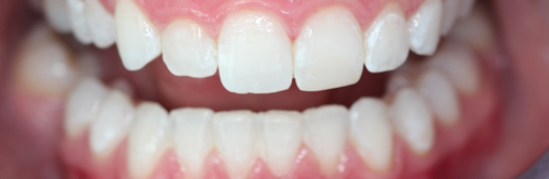 After tooth whitening treatment at Orchard House Dental, Beckenham