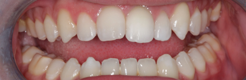 After whitening treatment at Orchard House Dental, Beckenham