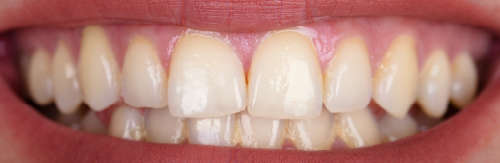 Before teeth whitening treatment at Orchard House Dental, Beckenham